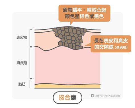 點痣 流血|點痣，原來這麼簡單－萊茵診所